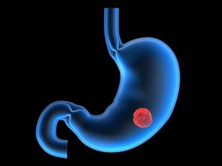 This patient information fact sheet provides information on stomach cancer, causes, diagnosis, ulcers, symptoms, and treatment. This patient information fact sheet provides information on stomach cancer, causes, diagnosis, ulcers, symptoms, and treatment.