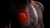 Congress Backs Medicare Coverage of Lung Cancer Screening Congress Backs Medicare Coverage of Lung Cancer Screening