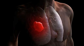 Women Harbor Misperceptions About Lung Cancer Women Harbor Misperceptions About Lung Cancer