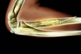 Study IDs Predictors of Late Recurrence in Soft Tissue Sarcomas Study IDs Predictors of Late Recurrence in Soft Tissue Sarcomas