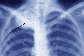In Study, Sorafenib Plus Everolimus for Osteosarcoma Fails to Reach Primary Endpoint In Study, Sorafenib Plus Everolimus for Osteosarcoma Fails to Reach Primary Endpoint