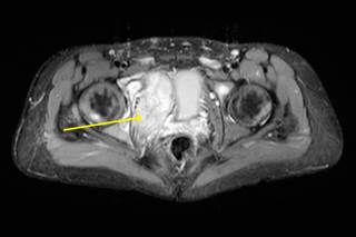 Evaluating Prognostic Factors for Localized Ewing Sarcoma Family of Tumors Evaluating Prognostic Factors for Localized Ewing Sarcoma Family of Tumors