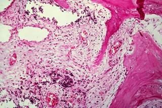 Significant reduction of late toxicities in extremity soft tissue sarcoma treated with preoperative image-guided radiation therapy. Significant reduction of late toxicities in extremity soft tissue sarcoma treated with preoperative image-guided radiation therapy.