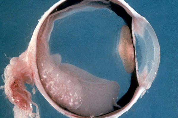 retinoblastoma