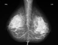 Full-Field Digital Mammography Linked to Lower Recall, Biopsy Rates Full-Field Digital Mammography Linked to Lower Recall, Biopsy Rates