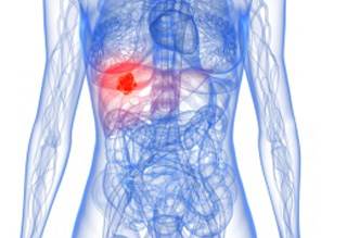 Lipiodol Earns FDA Approval for Tumor Imaging in HCC Lipiodol Earns FDA Approval for Tumor Imaging in HCC