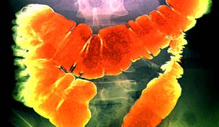 FDA Approves First-Line Treatment, Companion Diagnostic for mCRC FDA Approves First-Line Treatment, Companion Diagnostic for mCRC