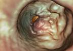 New Treatments for Metastatic Colorectal Cancer New Treatments for Metastatic Colorectal Cancer