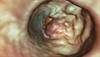New Treatments for Metastatic Colorectal Cancer New Treatments for Metastatic Colorectal Cancer