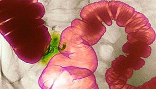 Cancer Risk No Higher With TNF-alpha Antagonist Exposure in IBD Cancer Risk No Higher With TNF-alpha Antagonist Exposure in IBD