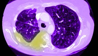 Non-Small Cell Lung Cancer in Never-Smokers Non-Small Cell Lung Cancer in Never-Smokers