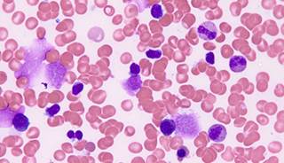 Not all adverse events were documented, making it “difficult to make firm conclusions regarding the overall toxicity” of added palifosfamide Not all adverse events were documented, making it “difficult to make firm conclusions regarding the overall toxicity” of added palifosfamide