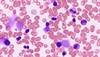 Does Palifosfamide With Platinum Doublet Prolong SCLC Survival? Does Palifosfamide With Platinum Doublet Prolong SCLC Survival?