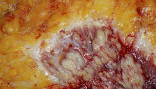 Emerging Therapeutic Approaches in Triple-Negative Breast Cancer Emerging Therapeutic Approaches in Triple-Negative Breast Cancer