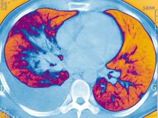 HIV-Infected Population May Have Higher Cancer Burden and Lower Cancer Survival Rates HIV-Infected Population May Have Higher Cancer Burden and Lower Cancer Survival Rates