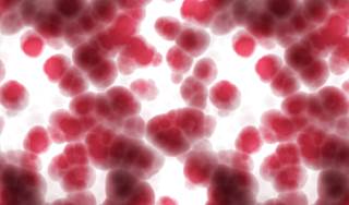 Review of Consensus Recommendations on Plasma Cell Leukemia Review of Consensus Recommendations on Plasma Cell Leukemia
