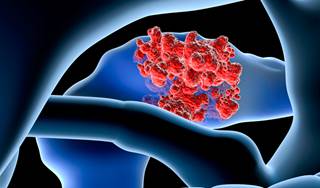 New Standard of Care Emerges for Pancreatic Cancer New Standard of Care Emerges for Pancreatic Cancer