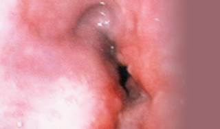 Localized, early-stage esophageal cancer might not favor endoscopic resections Localized, early-stage esophageal cancer might not favor endoscopic resections