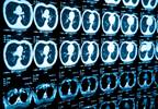 Low Life Expectancy Tied to Cancer Screening Low Life Expectancy Tied to Cancer Screening