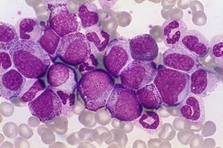 Age less than 45 years of age and digital-PCR (dPCR) positivity are significantly associated with relapses in CML. Age less than 45 years of age and digital-PCR (dPCR) positivity are significantly associated with relapses in CML.
