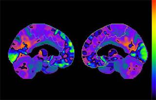 Researchers Find New Insight Into Brain Cancer and Parkinson's Disease Researchers Find New Insight Into Brain Cancer and Parkinson's Disease