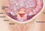 High Serum Calcium May Indicate Preclinical Ovarian Cancer High Serum Calcium May Indicate Preclinical Ovarian Cancer