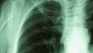 ALK Inhibitors and Non-Small Cell Lung Cancer: A Promising Advance in Targeted Therapy ALK Inhibitors and Non-Small Cell Lung Cancer: A Promising Advance in Targeted Therapy