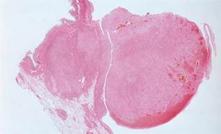 Synthetic hCG Metabolite May Fight Kaposi Sarcoma Synthetic hCG Metabolite May Fight Kaposi Sarcoma