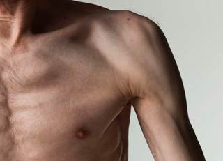 Cancer Cachexia: No Longer Simply Involuntary Weight Loss Cancer Cachexia: No Longer Simply Involuntary Weight Loss