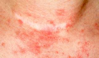 Association Between Cabozantinib and Skin Reactions in Patients with Urothelial Carcinoma Association Between Cabozantinib and Skin Reactions in Patients with Urothelial Carcinoma