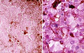 Trametinib + Dabrafenib Improves PFS in BRAFV600E/K Mutant Metastatic Melanoma Trametinib + Dabrafenib Improves PFS in BRAFV600E/K Mutant Metastatic Melanoma