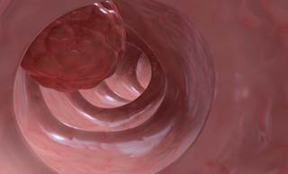 Neoadjuvant Capecitabine Equivalent to 5-FU for Rectal Cancer Neoadjuvant Capecitabine Equivalent to 5-FU for Rectal Cancer