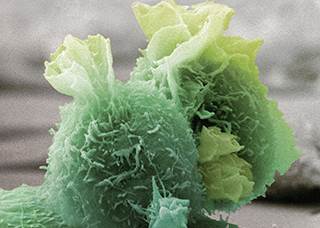 Colored scanning electron micrograph of sarcoma cells Colored scanning electron micrograph of sarcoma cells