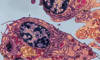 Patterns of Cadiotoxicity Associated With Carfilzomib Patterns of Cadiotoxicity Associated With Carfilzomib