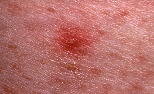 Early Lapatinib-Induced Skin Rash Predicts Better Survival 