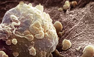 Melanoma cell / Photo Credit: Science Source Melanoma cell / Photo Credit: Science Source