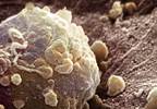 FDA Approves Trametinib/Dabrafenib Combination FDA Approves Trametinib/Dabrafenib Combination