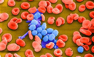 Absolute lymphocyte counts following fludarabine, cyclophosphamide, and rituximab are prognostic for survival among patients with chronic lymphocytic leukemia. Absolute lymphocyte counts following fludarabine, cyclophosphamide, and rituximab are prognostic for survival among patients with chronic lymphocytic leukemia.