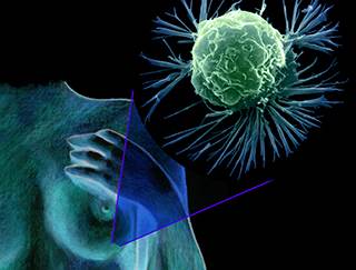 A biomarker can predict who will experience late breast cancer recurrence / Science Source A biomarker can predict who will experience late breast cancer recurrence / Science Source