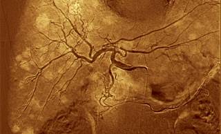 Benefits of HCC Screening Remain Unclear Benefits of HCC Screening Remain Unclear