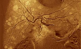 Drinking More Coffee May Lower Liver Cancer Risk Drinking More Coffee May Lower Liver Cancer Risk