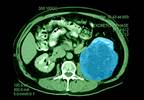 Jury Still Out on Whether Immunotherapy Can Cure Metastatic RCC Jury Still Out on Whether Immunotherapy Can Cure Metastatic RCC