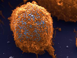 Patients with HIV Less Likely to Receive Cancer Treatment Patients with HIV Less Likely to Receive Cancer Treatment