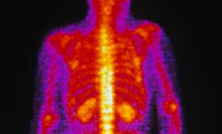 Thyroid Cancers More Advanced at Diagnosis Among Minorities, Poor Thyroid Cancers More Advanced at Diagnosis Among Minorities, Poor