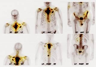 Bone scan showing multiple metastases / Science Source Bone scan showing multiple metastases / Science Source