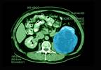 RCC Subtypes Affect Post-Surgery Cancer-Related Mortality Risk RCC Subtypes Affect Post-Surgery Cancer-Related Mortality Risk