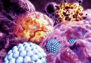 Nanoparticles (blue) destroying tumor (purple), causing their destruction (orange) / Science Source Nanoparticles (blue) destroying tumor (purple), causing their destruction (orange) / Science Source