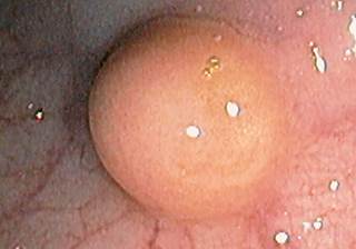 Endoscope showing a carcinoid tumor in a patient's rectum / Science Source Endoscope showing a carcinoid tumor in a patient's rectum / Science Source