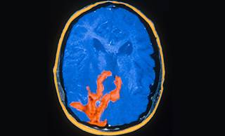 MRI of glioblastoma multiforme / Science Source MRI of glioblastoma multiforme / Science Source