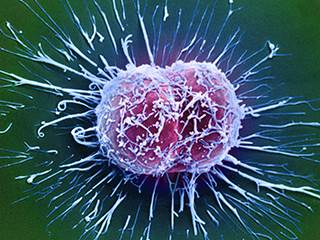 For cervical cancer, tattoos could mimic metastasis on PET fused with CT imaging. For cervical cancer, tattoos could mimic metastasis on PET fused with CT imaging.